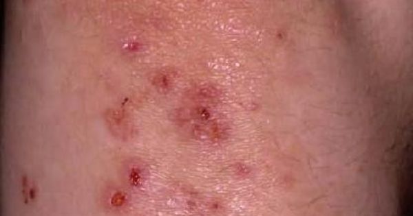 Dermatitis Herpetiformis Rash Seen In Coeliac Disease Aka Gluten