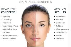 Chemical Peel San Antonio Chemical Peels Stone Oak Area San Antonio