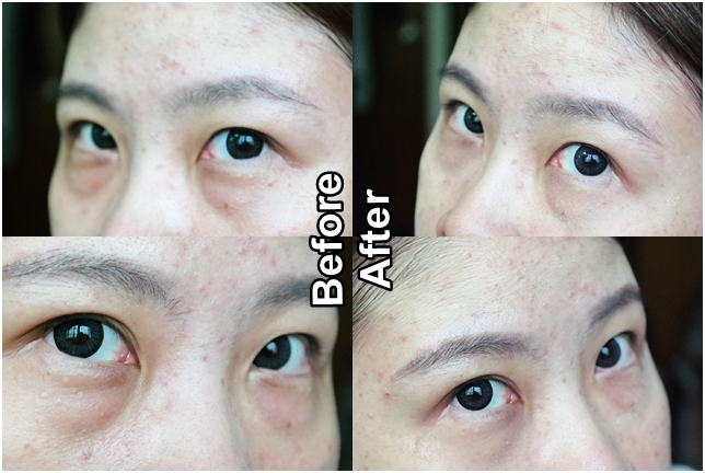 How To Get Rid Of And Remove Eye Bags Instantly Ageless