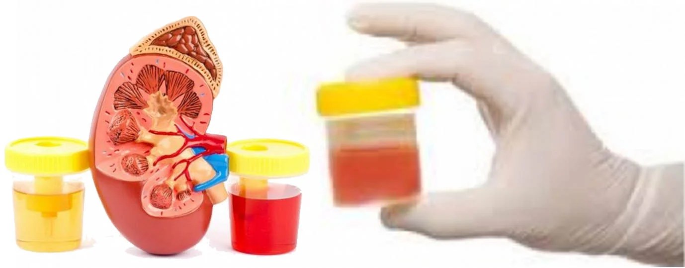 Hematuria Fundacion Sonria