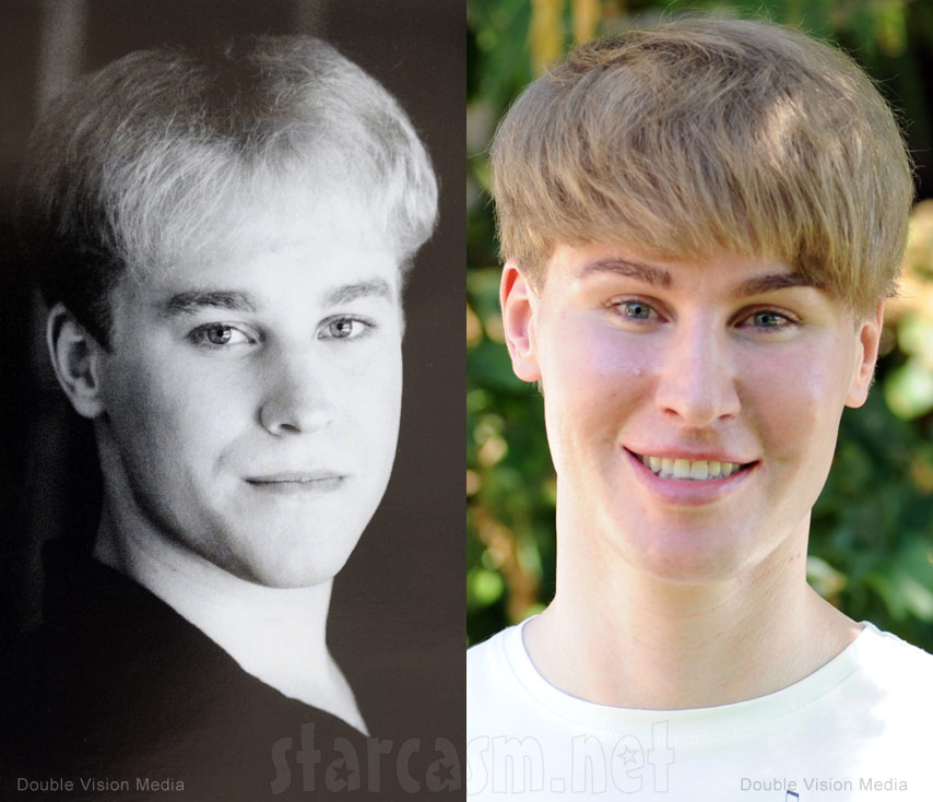 Toby Sheldon has 100k worth of plastic surgery to look like Justin Bieber