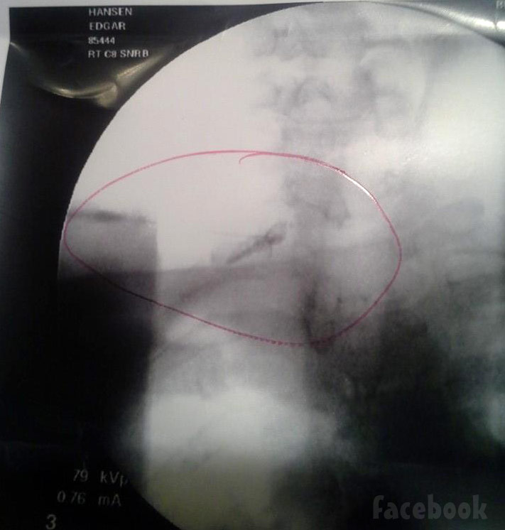 Deadliest Catch Edgar Hansen neck injury x-ray