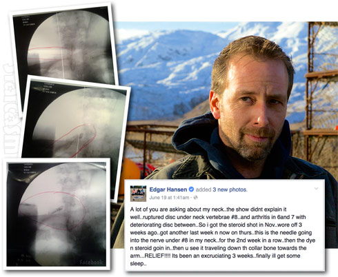 Deadliest Catch Edgar Hansen spine injury update