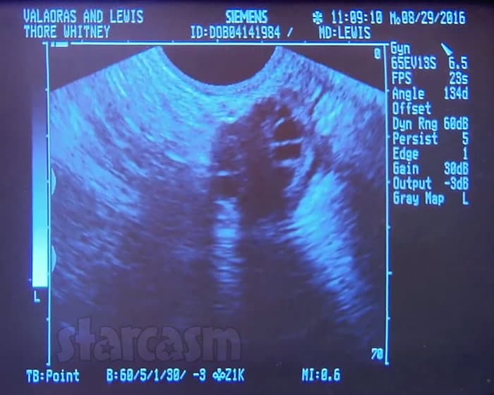 Whitney Way Thore pregnant sonogram