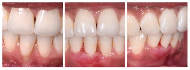 Gum Grafts And Surgeries Stouffville Smiles Dentistry