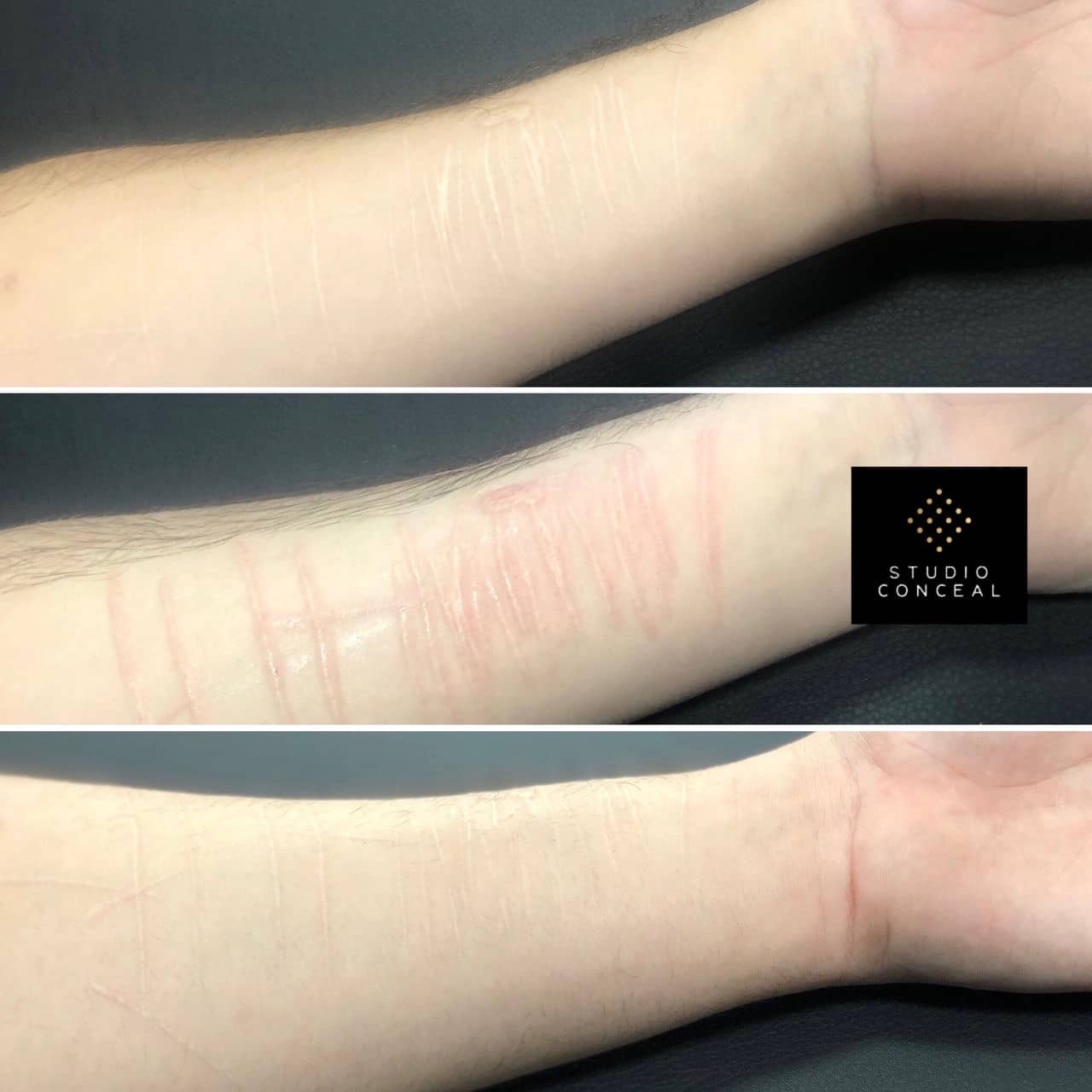 Self Harm Scar Tattoo Camouflage Studio Conceal