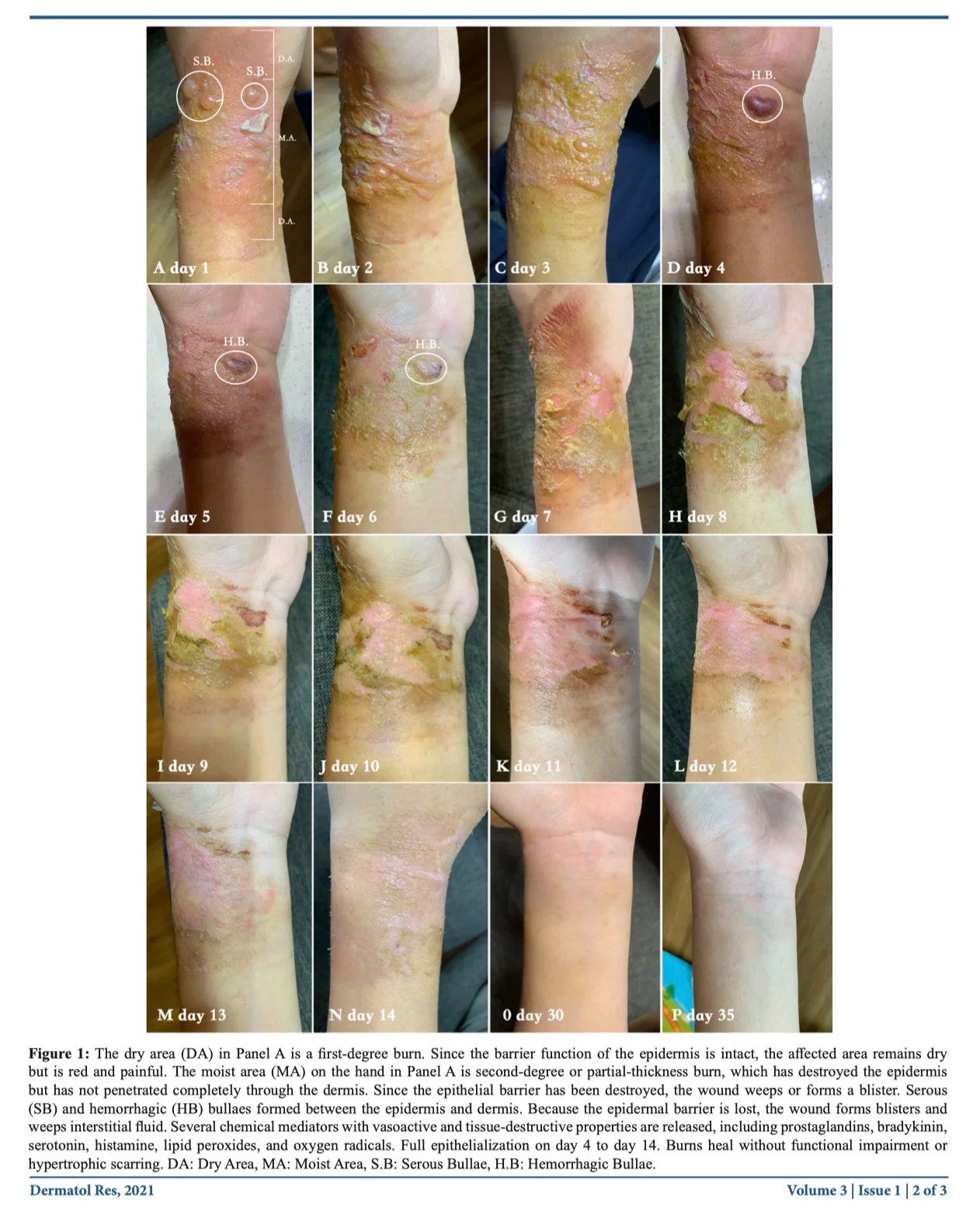 Second Degree Burn Healed In 10 Days With Herbal Formulated Hlq Ointment Tangs Clinical Tcm