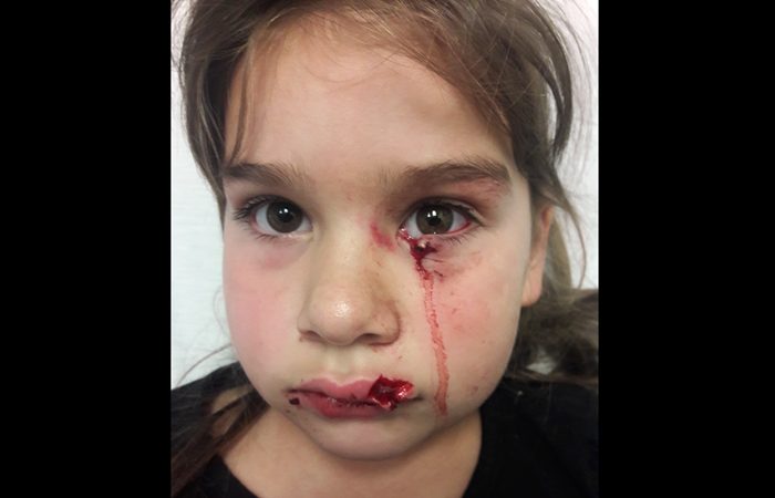 Gabriella Gonzales was attacked by a pit bull
