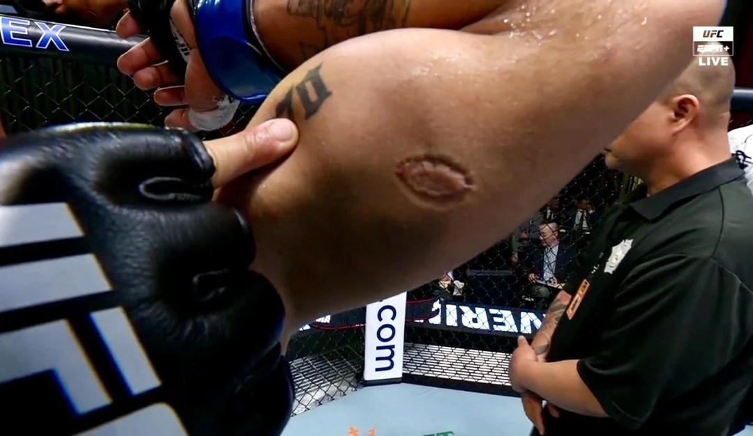 UFC News: Fighter Disqualified After Biting Opponent & Drawing Blood VIDEO