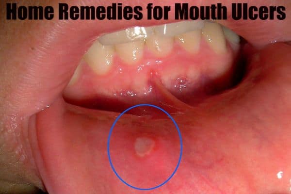 How To Cure Mouth Ulcers Naturally Thingscouplesdo