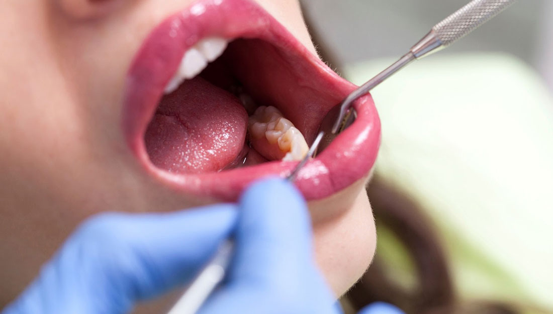 Wisdom Teeth What To Expect After The Extraction Vital Record