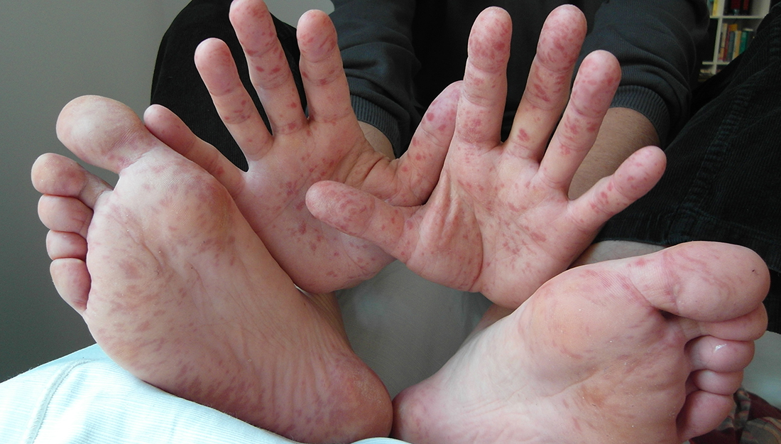 Hand Foot And Mouth Disease Signs Symptoms And Treatment Vital Record