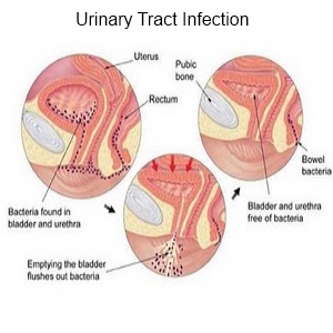 Curious Case Of Icd 10 Code For Urosepsis Medical Coding Guide