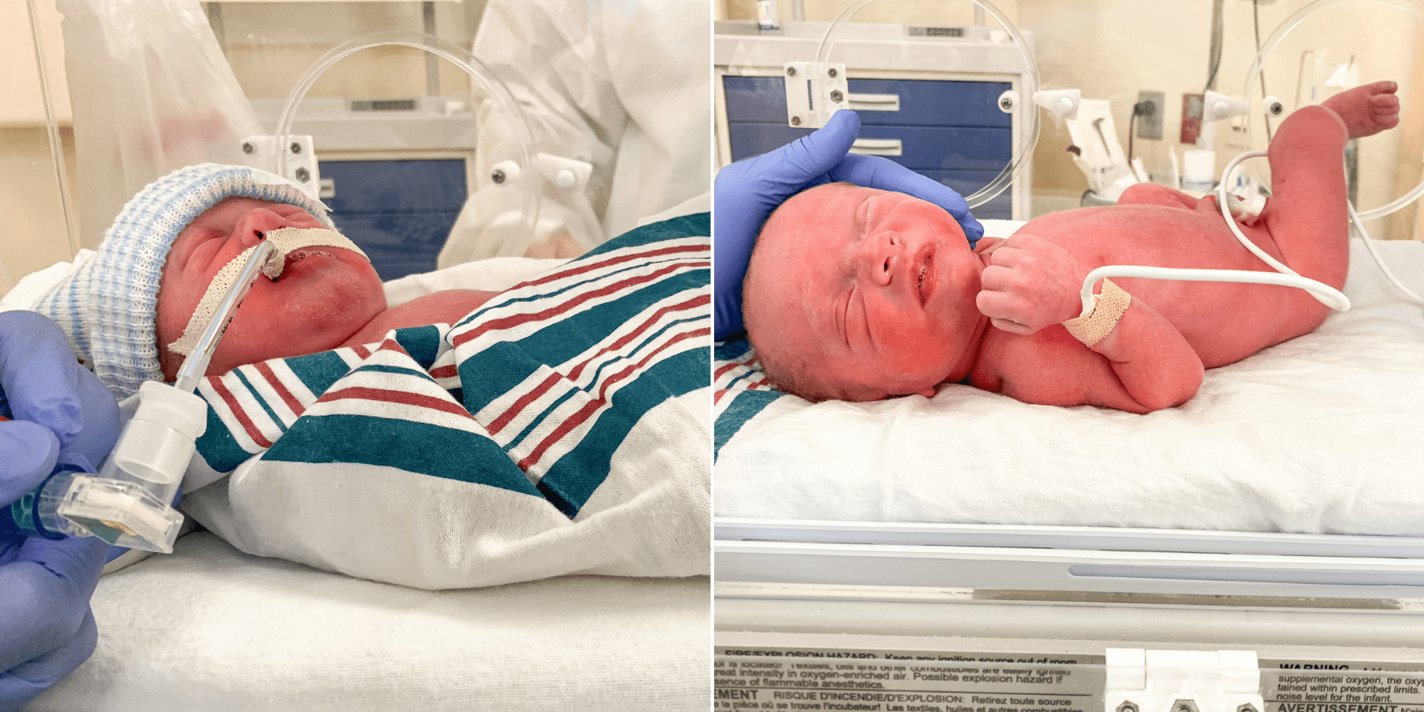 Twins Born At 33 Weeks And 3 Days Our Twin Birth Story