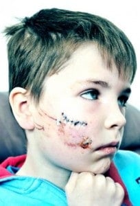 9 year old boy bitten by Yorkshire Terrier