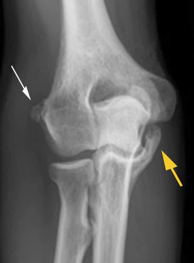 49-year-old woman with retinoic acid arthropathy. Anteroposterior radiograph of the right elbow shows hyperostosis…