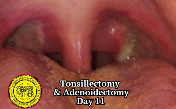 Tonsillectomy Recovery Week 2 Page 4 Of 7 Courageous Christian Father