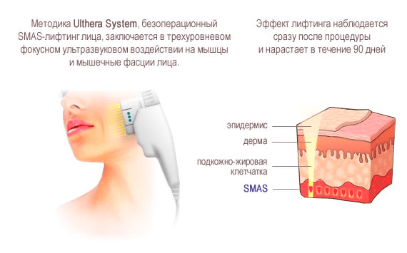 ulthera-4