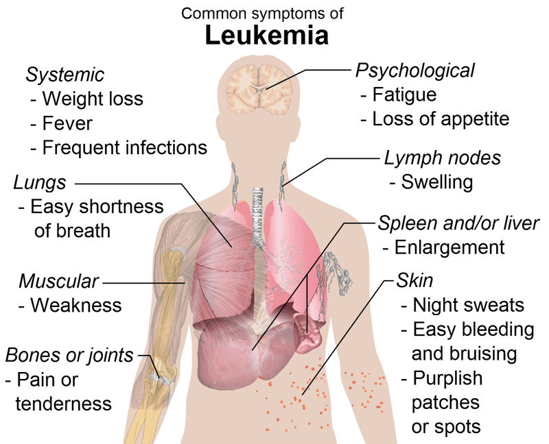 Difference Between Leukemia and Multiple Myeloma