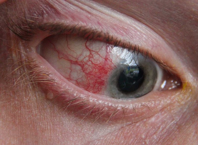 Difference Between Scleritis and Episcleritis