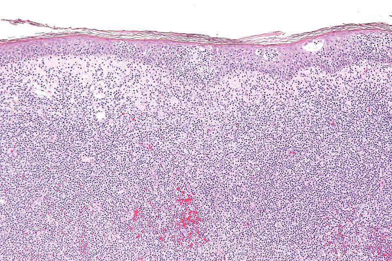 Difference Between B Cell and T Cell Lymphoma