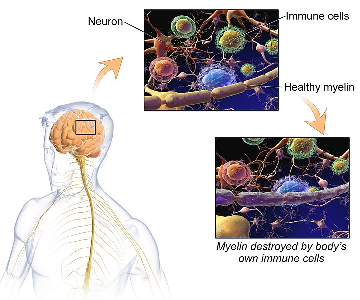 Key Difference - MS vs Parkinson’s 