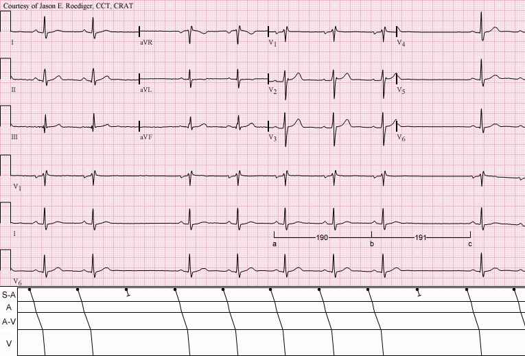 Key Difference Between Sinus Arrest and Sinus Block