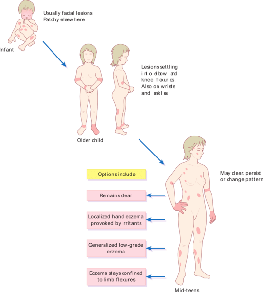 Difference Between Atopic Dermatitis and Eczema