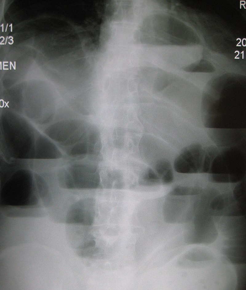 Difference Between Small and Large Bowel Obstruction