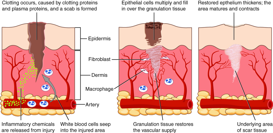 Difference Between Granulation Tissue and Granuloma