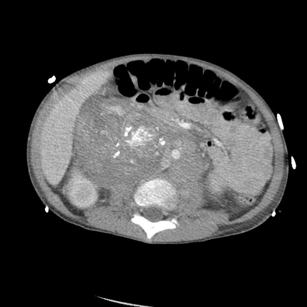  Neuroblastoma vs Wilms Tumor in Tabular Form