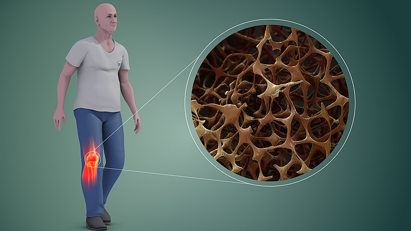 Osteogenesis Imperfecta and Osteoporosis - Side by Side Comparison 