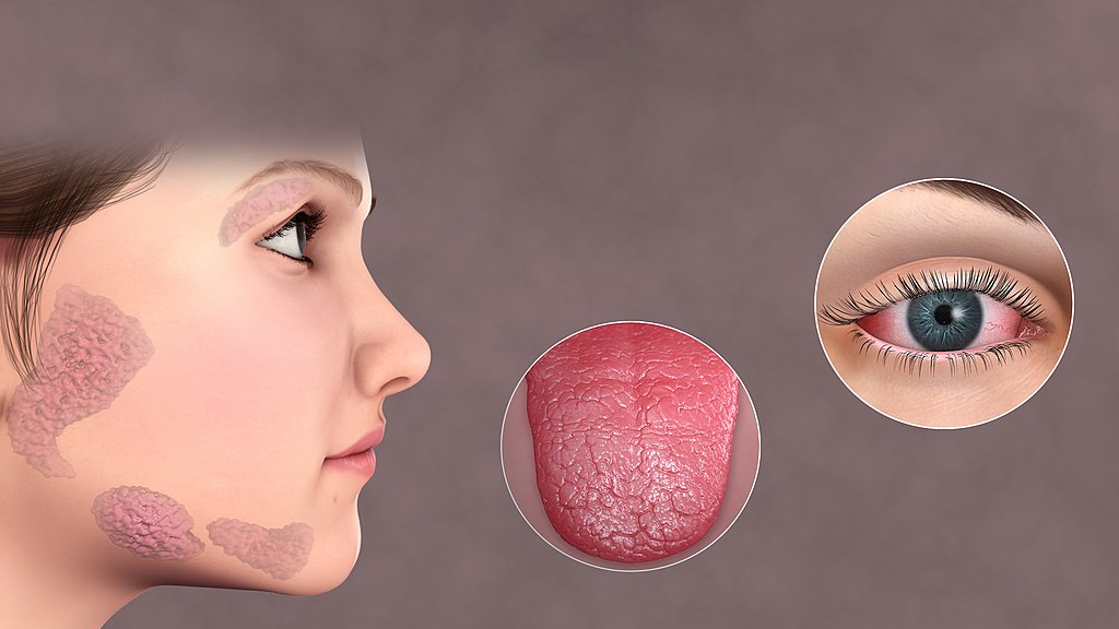 Lupus and Sjogren's Syndrome - Side by Side Comparison 