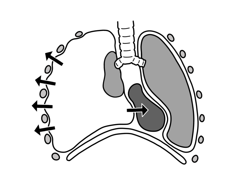 Pneumothorax vs Tension Pneumothorax in Tabular Form