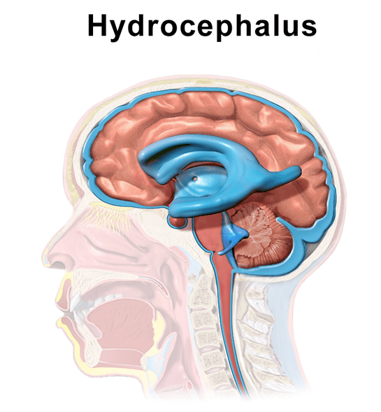 Communicating vs Noncommunicating Hydrocephalus in Tabular Form