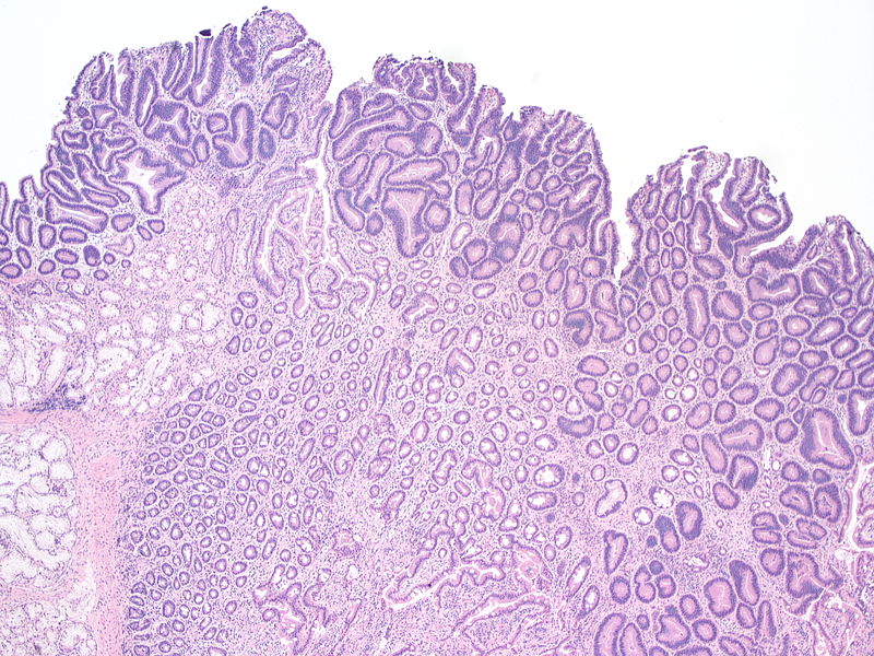 Hyperplastic and Adenomatous Polyp - Side by Side Comparison 