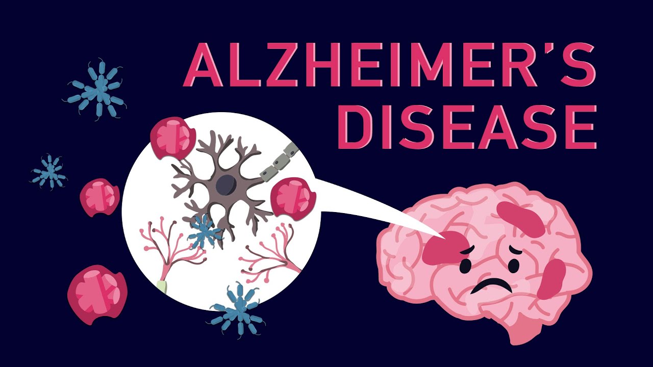 Memory Loss Vs Alzheimer S Disease All You Need To Know