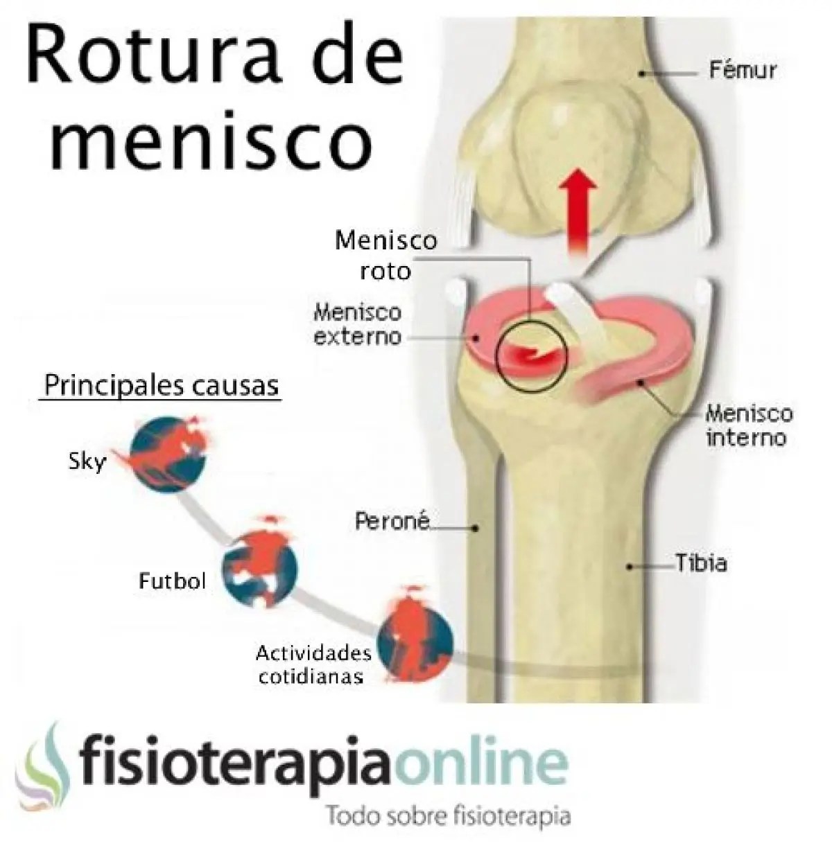 Lista 92+ Foto Que Es Un Menisco En Química Mirada Tensa Lista 92+ Foto Que Es Un Menisco En Química Mirada Tensa