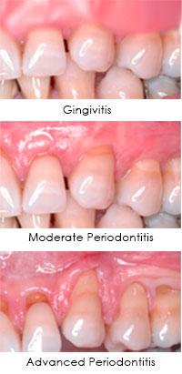 Gum Disease Linked To Rheumatoid Arthritis Greenwich Cosmetic Dentistry