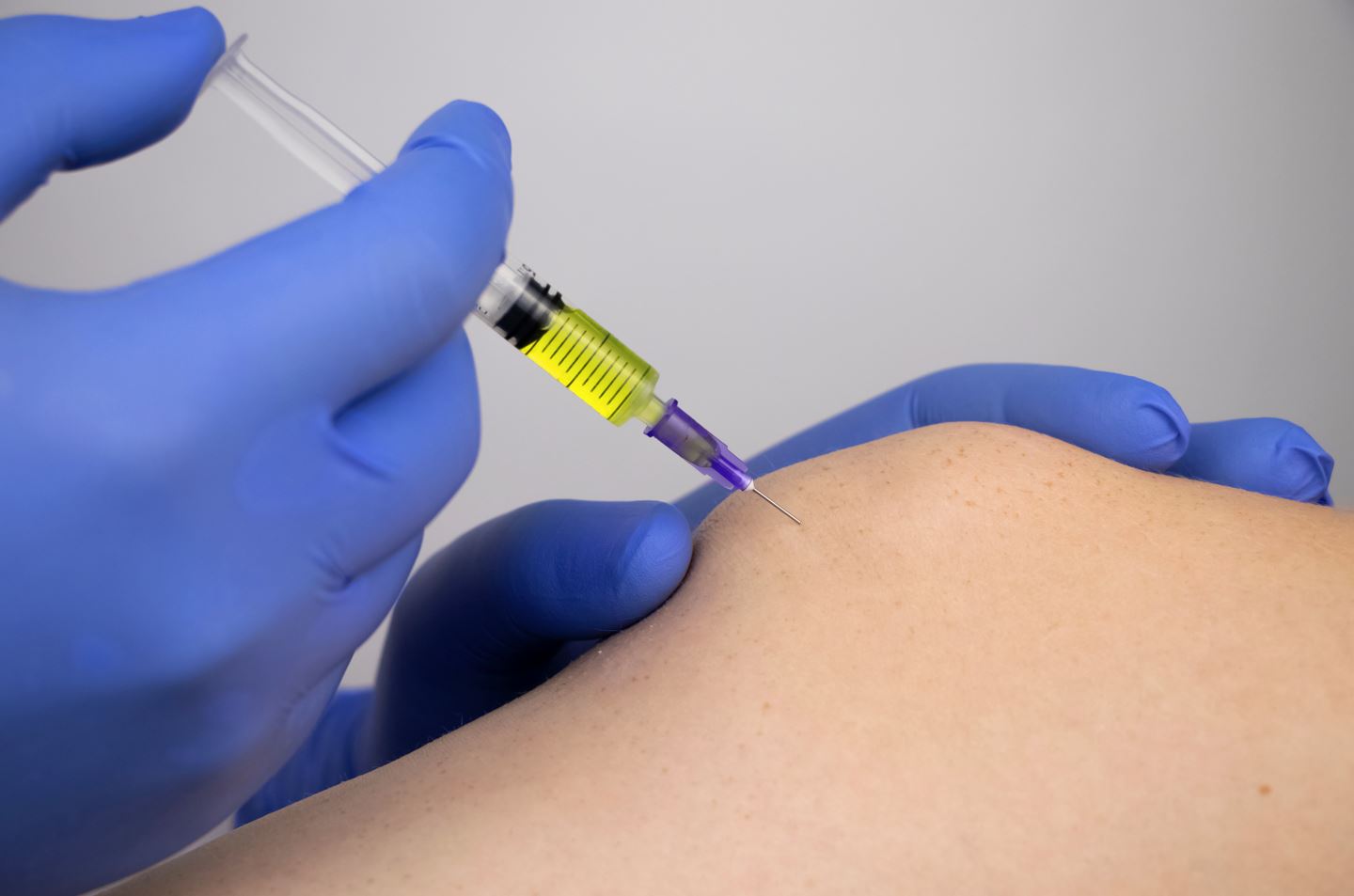 Prolotherapy prolotherapy is a nonsurgical procedure promotes the body’s natural healing processes to strengthen joints weakened by trauma or arthritis.
