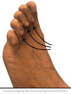 Hammertoe Surgery Cost In Uk Toe Shortening Straightening Surgery Harley Street London