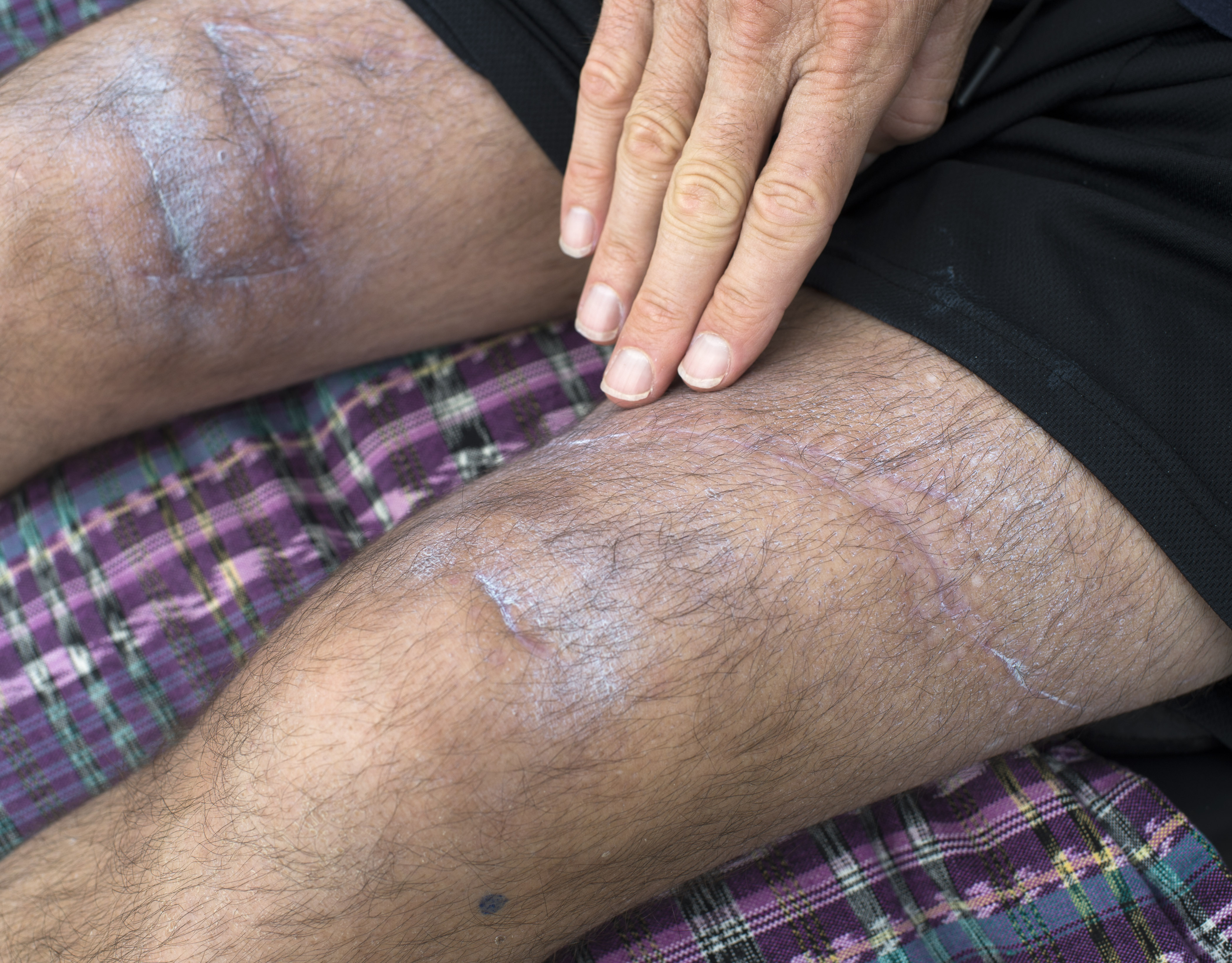 In Pacific Grove, Calif., on Thursday, Sept. 1, 2022, Steve Bruemmer shows some of the scars he sustained after being bitten by a large great white shark while swimming on June 22, 2022, at Lovers Point. Bruemmer is a member of the Kelp Krawlers, a group of open-water swimmers and triathletes who swim at Lovers Point and other locations. He is now in a wheelchair and in rehab. (Doug Duran/Bay Area News Group)