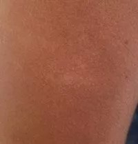 Des Taches Blanches Sur La Peau Est Ce Un Pityriasis Versicolor Monpediatre Net