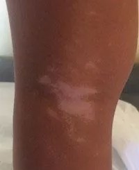 Des Taches Blanches Sur La Peau Est Ce Un Pityriasis Versicolor Monpediatre Net