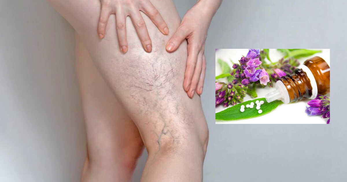 Capillari Fragili E Varici Rimedi Omeopatici Natural Magazine