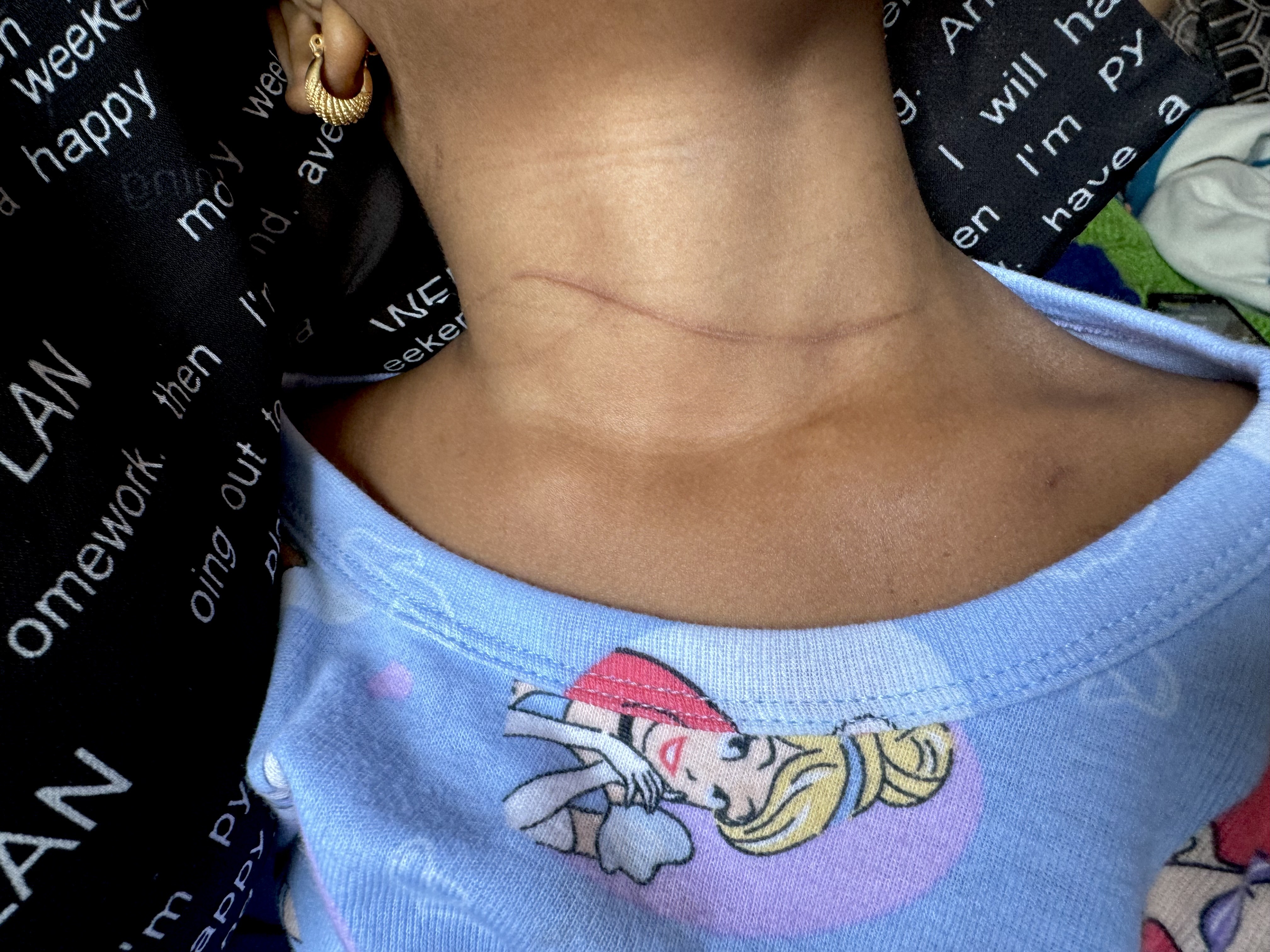 A scar on the throat of Gianna, 3, daughter of Lourdes Salvant, is pictured Monday, July 8, 2024. Salvant believes her daughter's father, Romney Desronvil, tried to slice her throat before trying to drown her. (Rebecca White for New York Daily News)