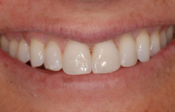 How To Fix A Chipped Tooth Or A Broken Tooth Causes Treatment Recovery Right Choice Dental Care