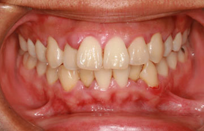 Periodontal Gum Disease Causes Treatments And Prevention Naperville Il
