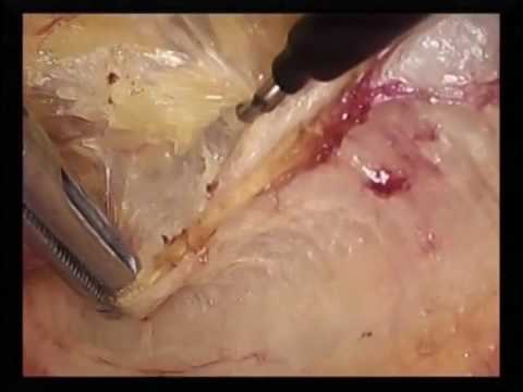 Operative Repair Of Sports Hernia From The Sages Video Library