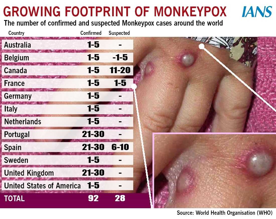 Experts Warn Of Unusual Monkeypox Outbreak In Aus Social News Xyz